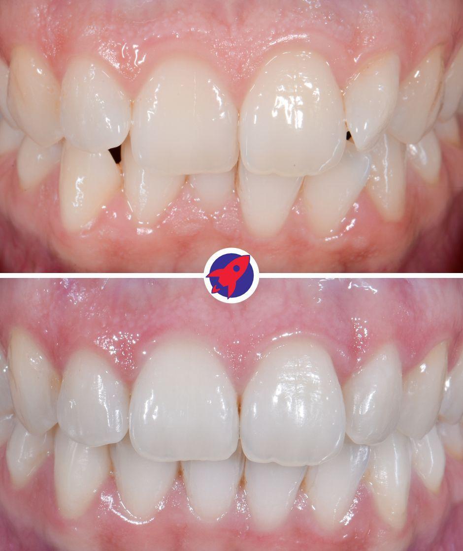 <p class="p1">Invisalign for a new, healthy smile</p>