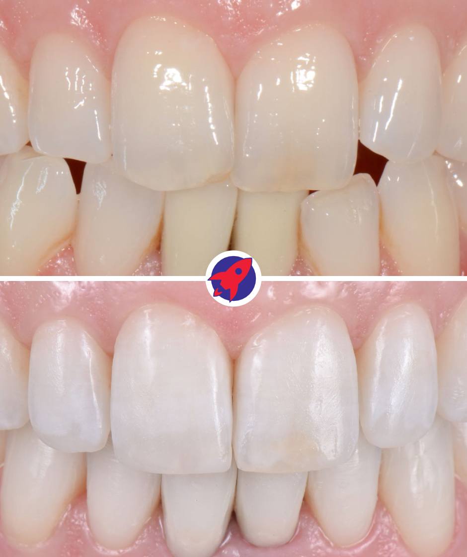 <p class="p1">Invisalign combined with professional bleaching</p>