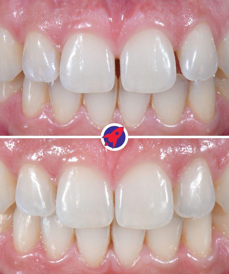 <p class="p1">Invisalign for an even smile</p>