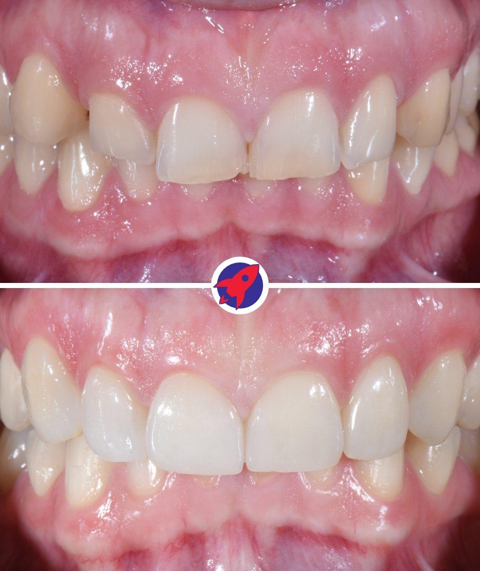 <p class="p1">From gaps to a harmonious smile</p>