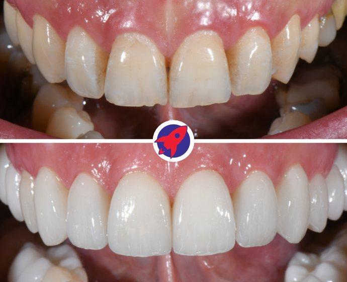 <p class="p1">Invisalign and veneers for aesthetic transformation</p>