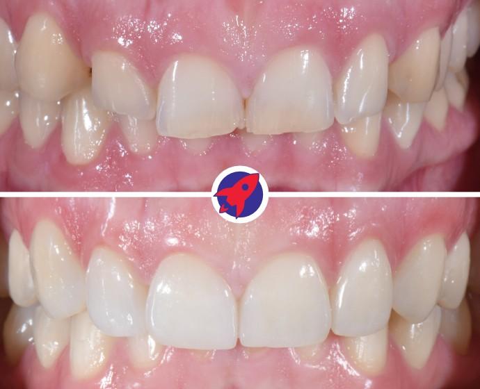 <p class="p1">From gaps to a harmonious smile</p>