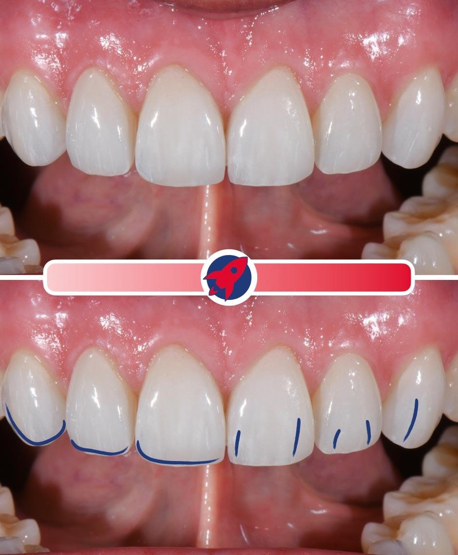 Individuelle Veneers mit mittlerer Charakterisierung, die die Balance zwischen einem natürlichen Look und persönlicher Anpassung demonstrieren.