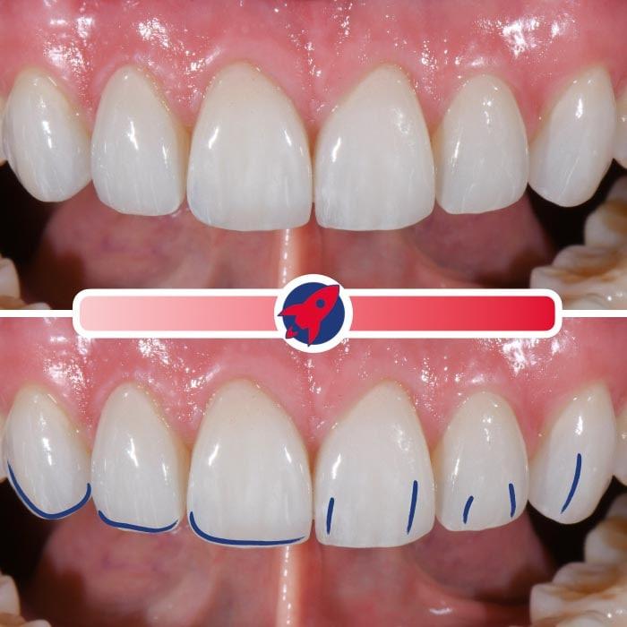 Individuelle Veneers mit mittlerer Charakterisierung, die die Balance zwischen einem natürlichen Look und persönlicher Anpassung demonstrieren.