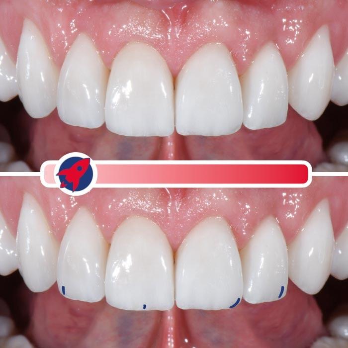 Dezent gestaltete Veneers, die für eine minimale Charakterisierung sorgen und ein helles, aber natürliches Lächeln unterstützen.