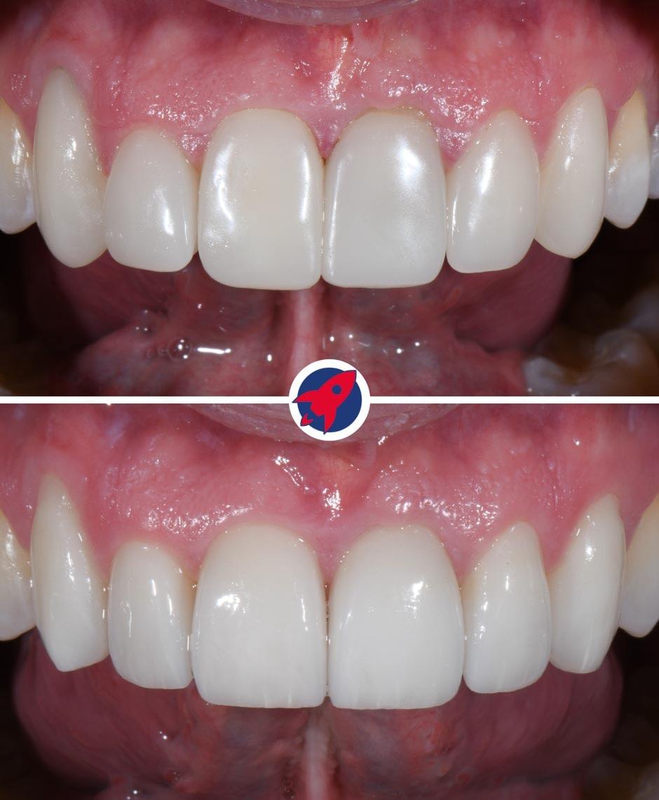 Six new veneers showing the great effect that can be achieved with individual veneers