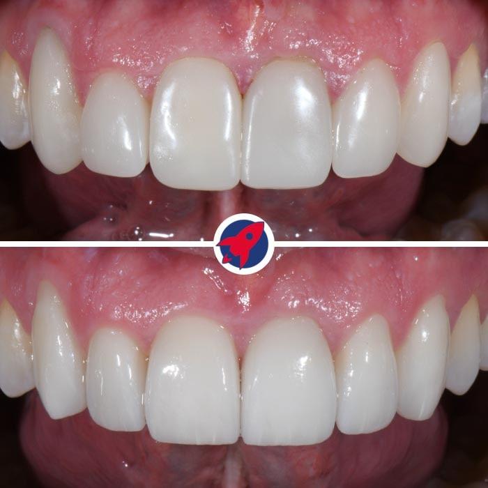 Six new veneers showing the great effect that can be achieved with individual veneers