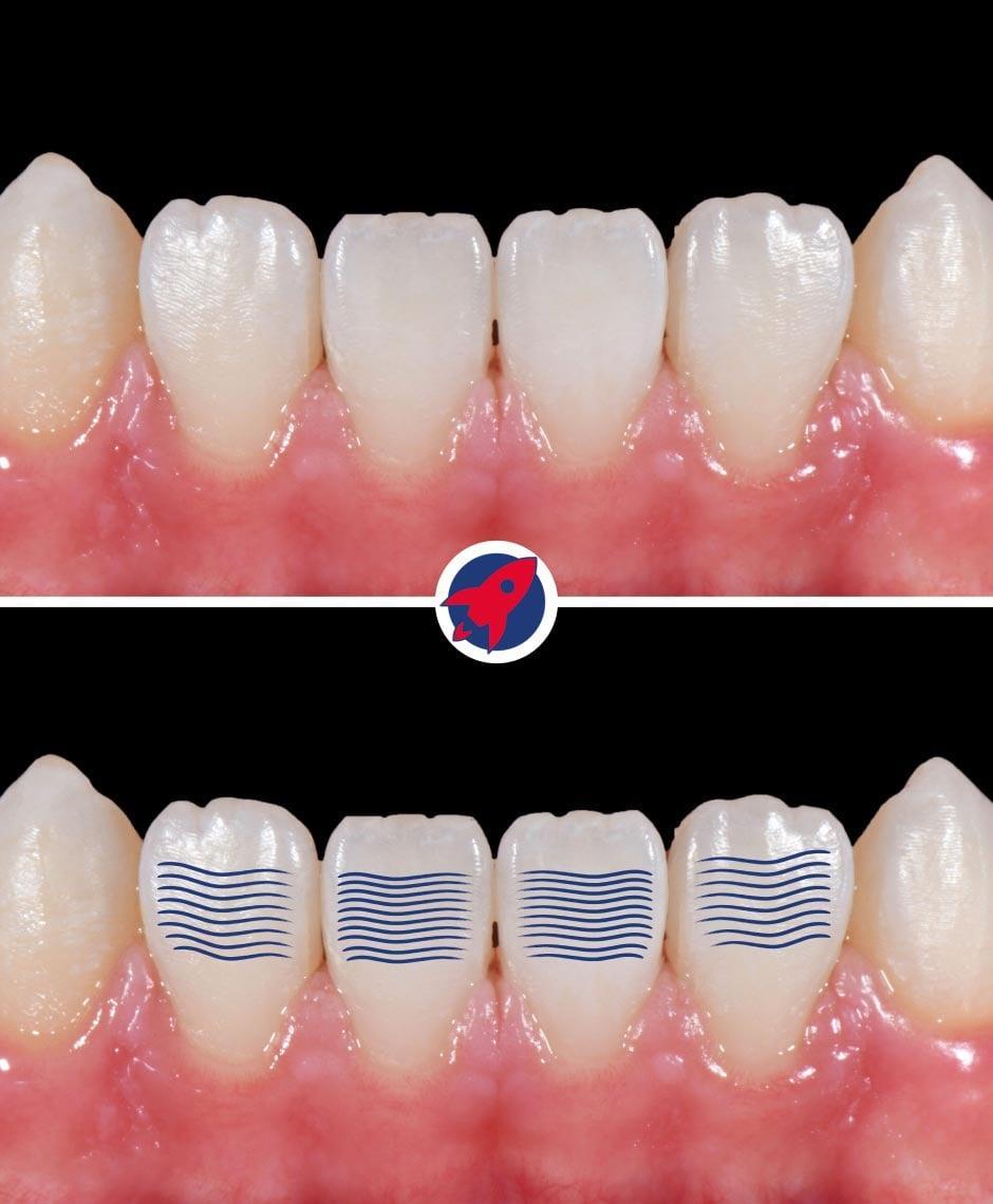 <p>Youthful dynamics through tooth surface design</p>