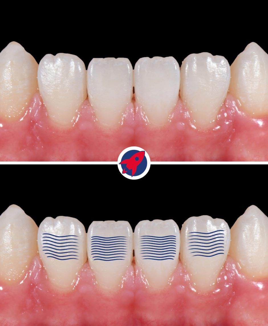 Detailaufnahme eines Lächelns zeigt die präzise gestalteten Oberflächenlinien der Veneers, die das natürliche Lichtspiel des Zahnschmelzes nachahmen.