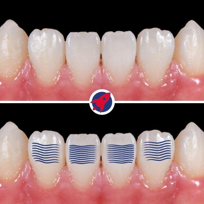 <p>Youthful dynamics through tooth surface design</p>