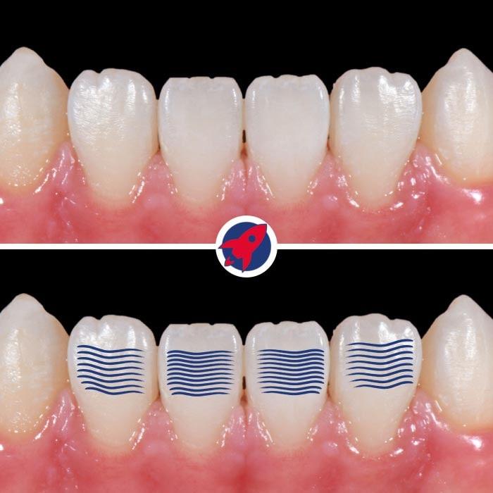 Detailaufnahme eines Lächelns zeigt die präzise gestalteten Oberflächenlinien der Veneers, die das natürliche Lichtspiel des Zahnschmelzes nachahmen.