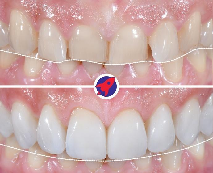 <p>Restore tooth length</p>