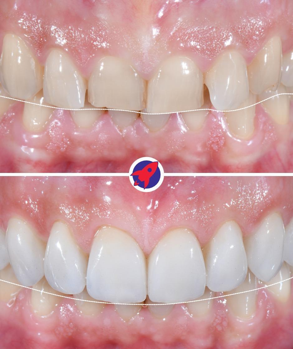 <p>Restore tooth length</p>