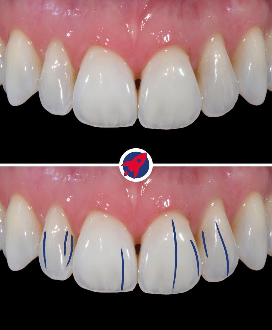 Nahaufnahme von Veneers, die mit feinen Rissen versehen sind, um die charakteristischen Merkmale des natürlichen Zahnschmelzes zu imitieren.