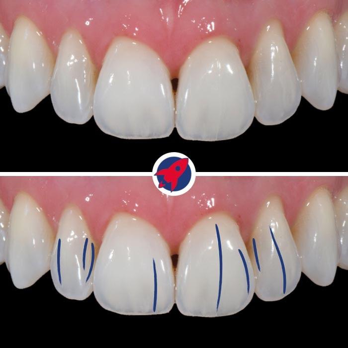 Nahaufnahme von Veneers, die mit feinen Rissen versehen sind, um die charakteristischen Merkmale des natürlichen Zahnschmelzes zu imitieren.