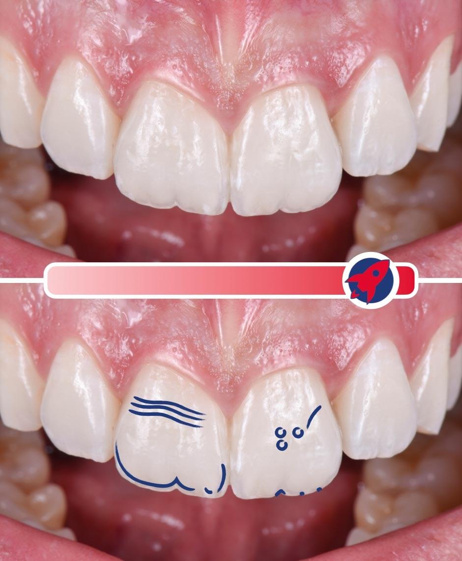 Hochgradig personalisierte Veneers, die eine starke Charakterisierung aufweisen und den einzigartigen Charakter des Patienten widerspiegeln.