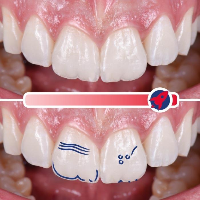 Hochgradig personalisierte Veneers, die eine starke Charakterisierung aufweisen und den einzigartigen Charakter des Patienten widerspiegeln.