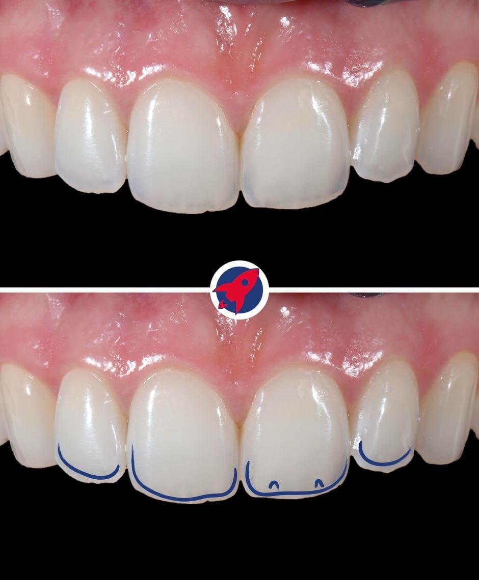 <p>Light transmission in dentistry</p>