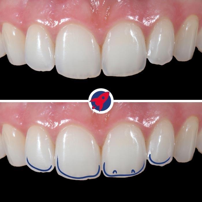 <p>Light transmission in dentistry</p>