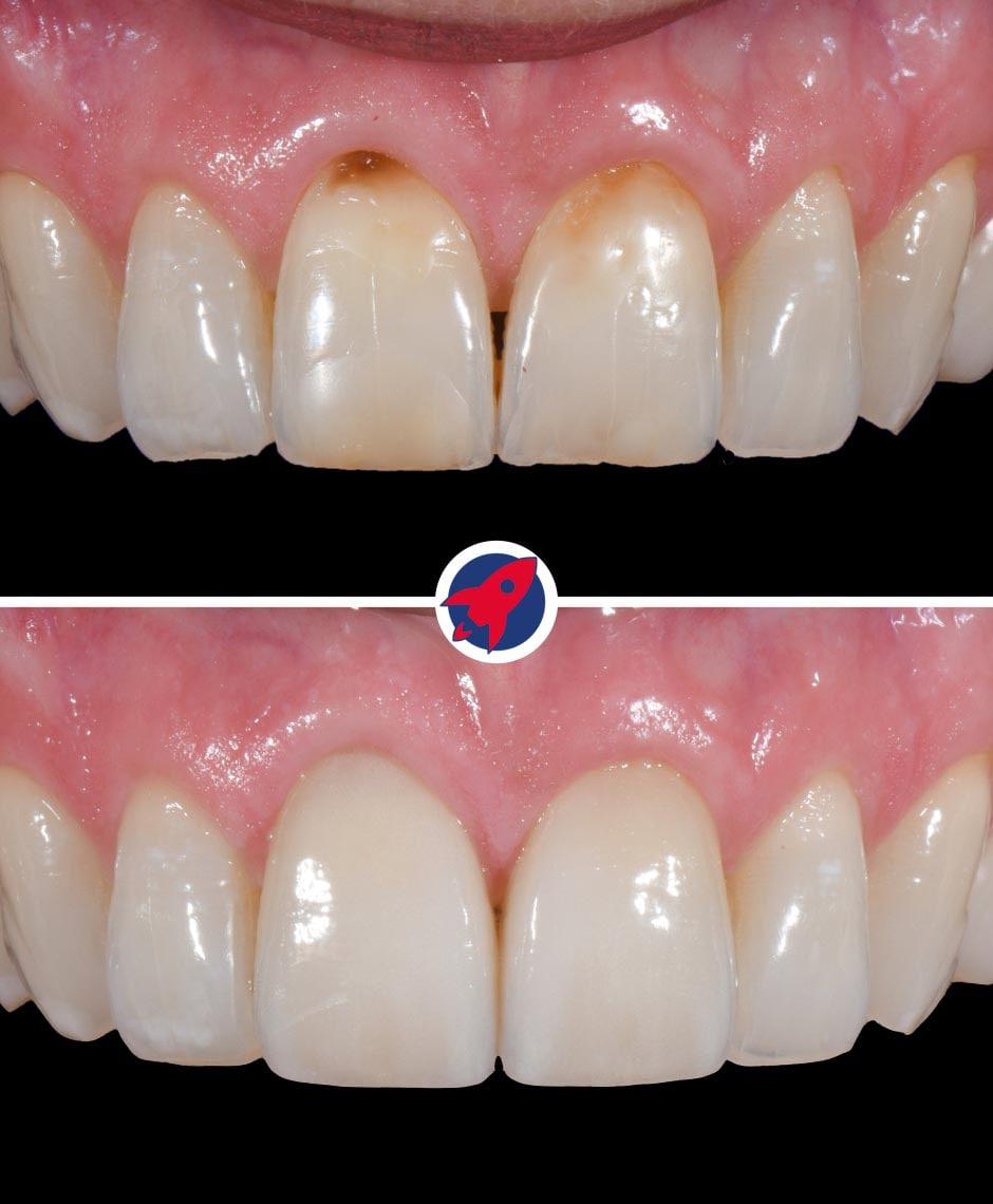 <p class="p1">Veneers for the two central incisors</p>