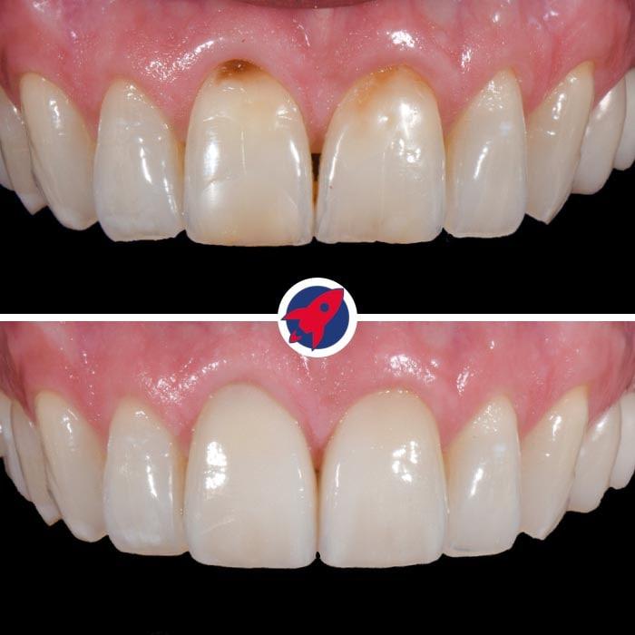 zwei veneers vorher-nachher bei stark verfärbten zähnen.