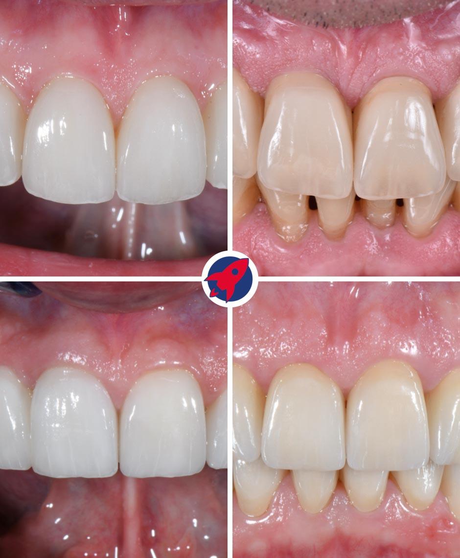 Die Vielfalt der Frontzahnästhetik bei Dr. Horvath: Individuell gestaltete Veneers demonstrieren unsere maßgeschneiderten Lösungen für Ihr perfektes Lächeln.