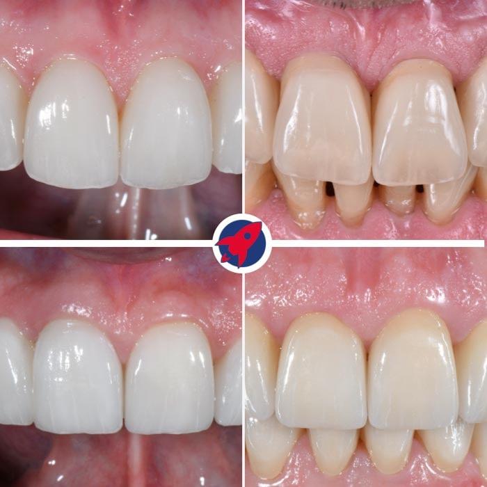 Die Vielfalt der Frontzahnästhetik bei Dr. Horvath: Individuell gestaltete Veneers demonstrieren unsere maßgeschneiderten Lösungen für Ihr perfektes Lächeln.