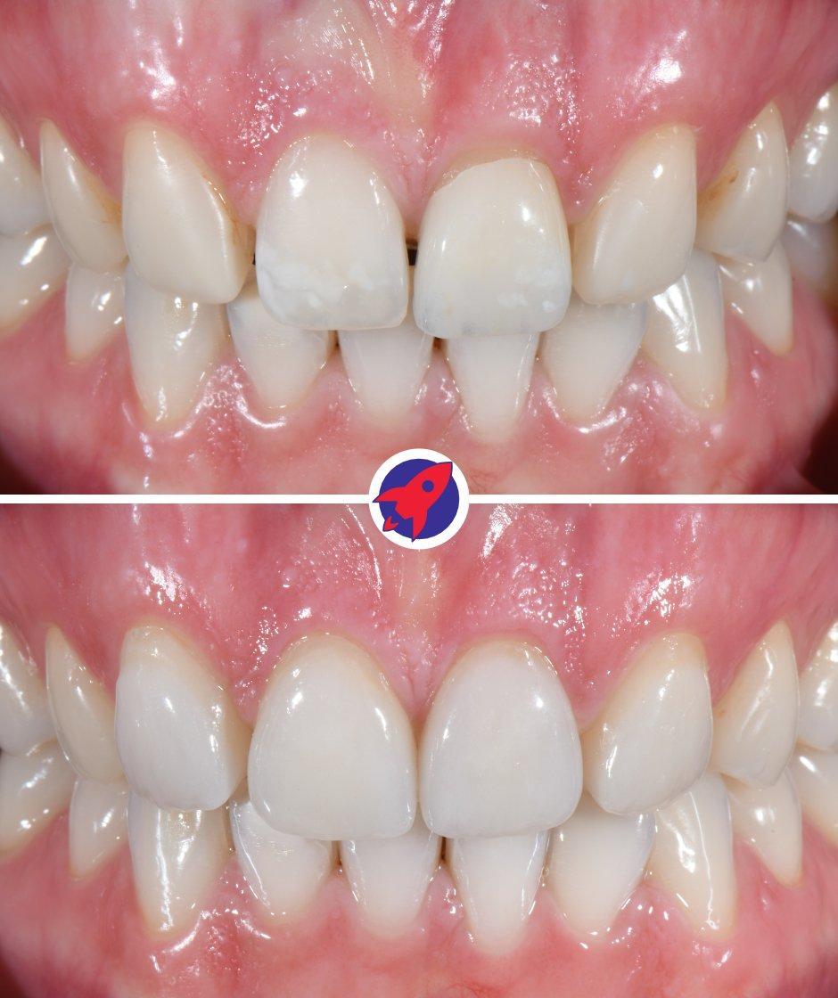 <p class="p1">Custom veneers for a natural appearance</p>