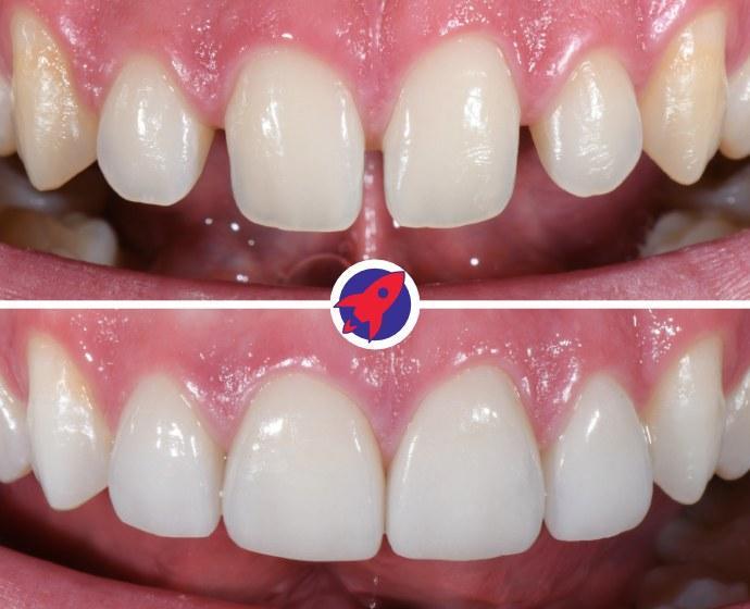 <p class="p1">Invisalign and veneers for a harmonious smile</p>