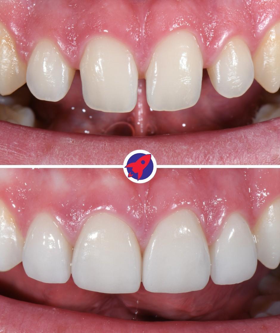<p class="p1">Invisalign and veneers for a harmonious smile</p>