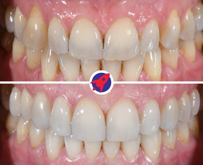 <p class="p1">Invisalign and veneers for a healthy smile</p>