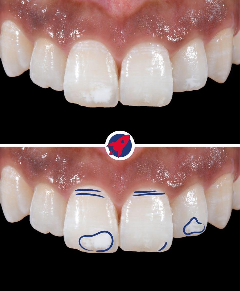 Natürlich aussehende Veneers, individuell gestaltet mit White Spots, die ein jugendliches Erscheinungsbild der Zähne erzeugen.