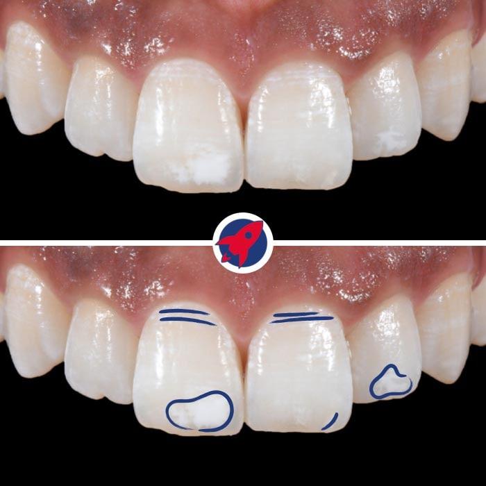 Natürlich aussehende Veneers, individuell gestaltet mit White Spots, die ein jugendliches Erscheinungsbild der Zähne erzeugen.