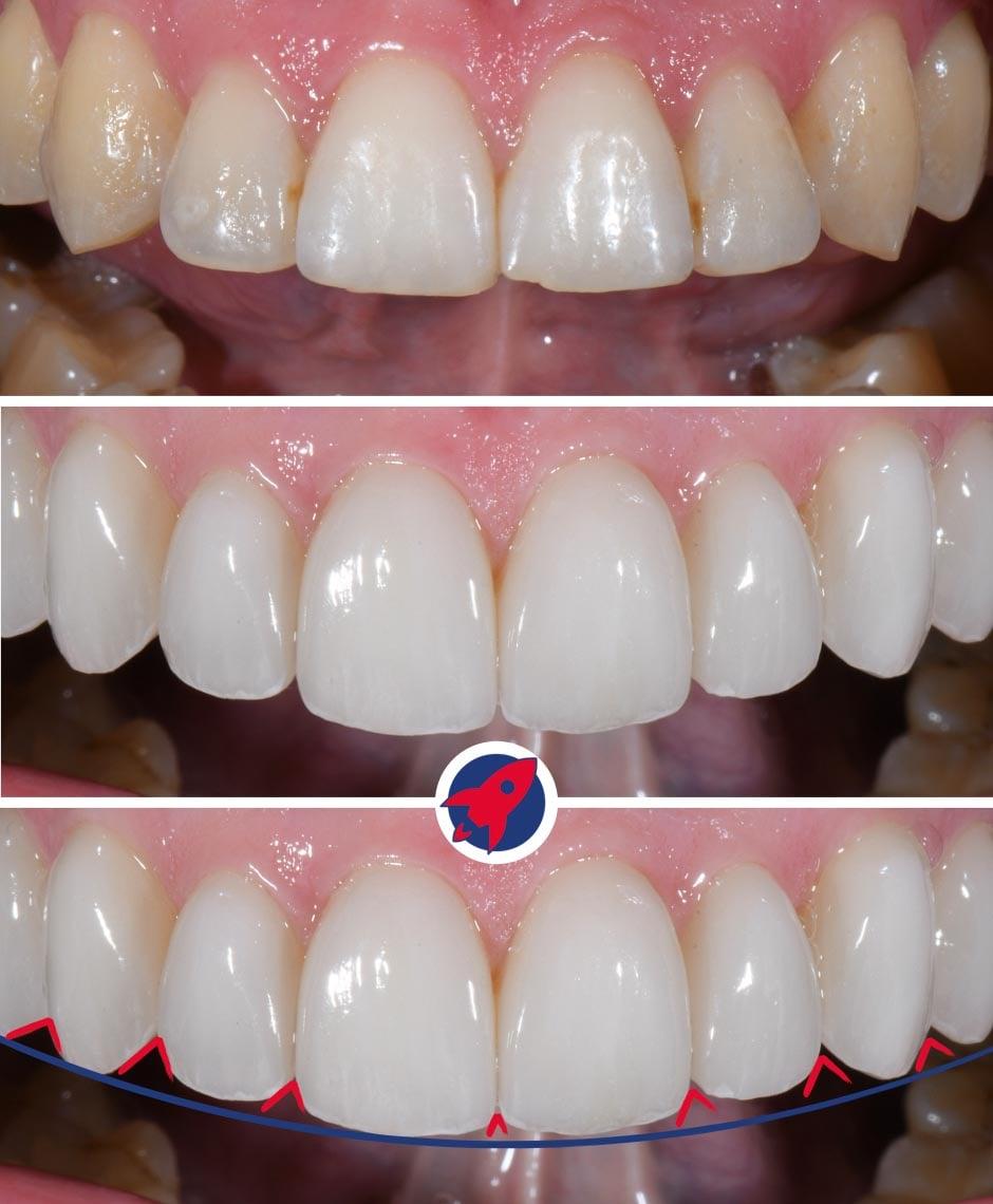 <p>From pointed to open</p>