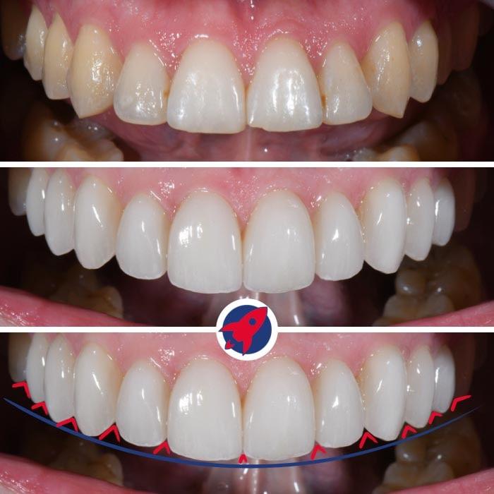 Der präzise Bogen der Inzisalkanten, illustriert an einem Fallbeispiel aus unserer Praxis Dr. Horvath, zeigt die Wichtigkeit harmonischer Konturen für ein ästhetisches Lächeln.
