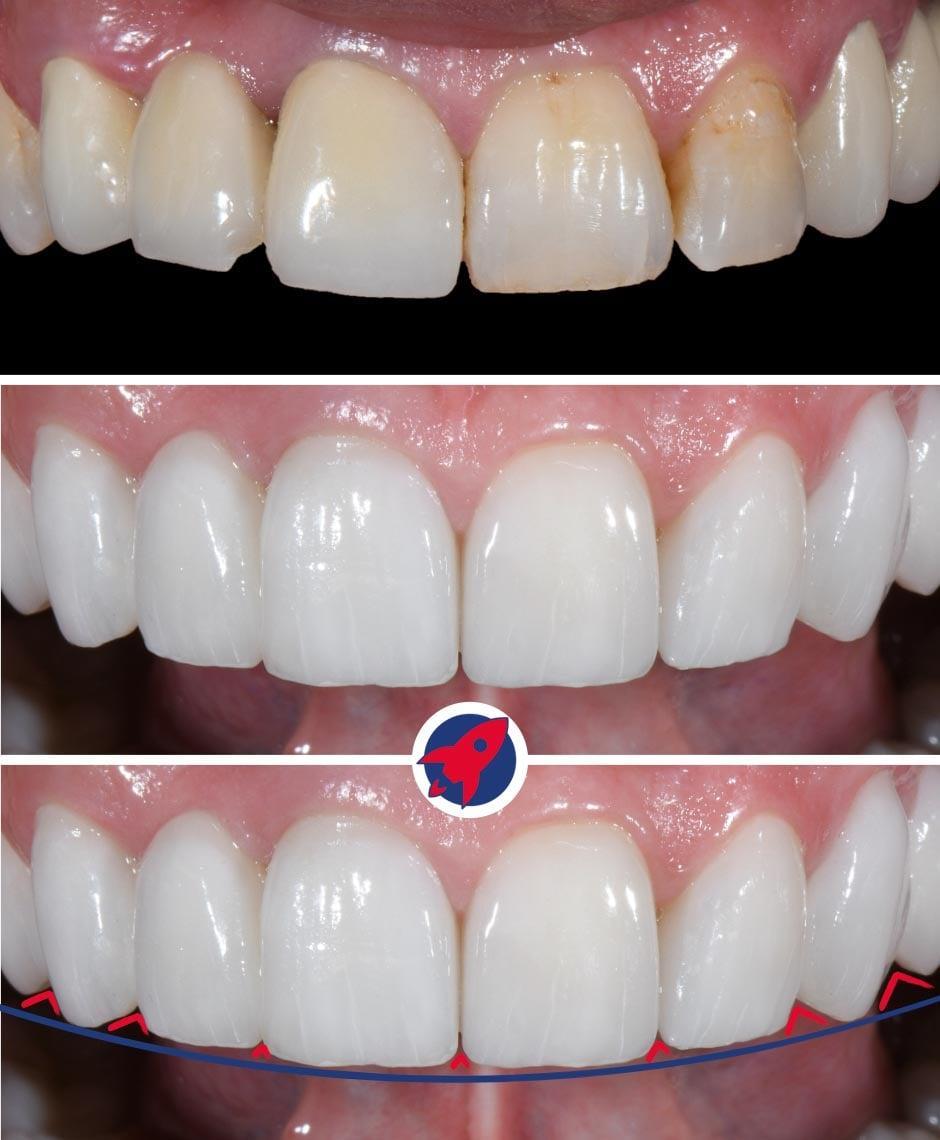 <p>Dominant smile, teeth of equal length</p>