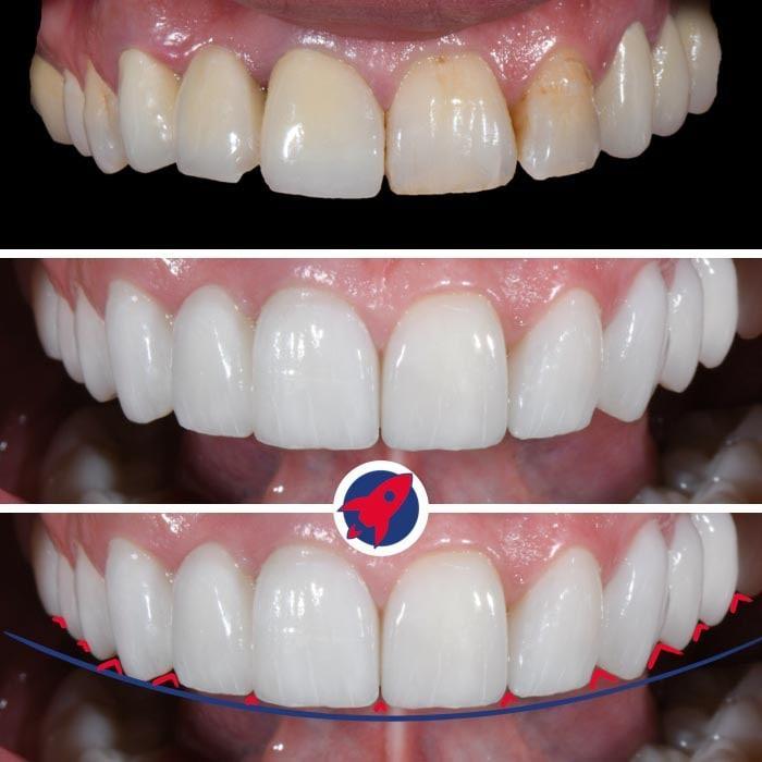 <p>Dominant smile, teeth of equal length</p>