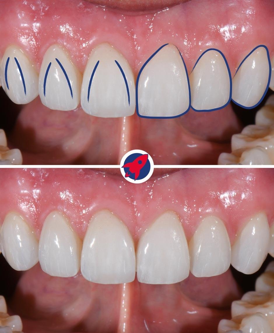 Detailaufnahme der Zahnform mit Lineangles bei Dr. Horvath: Einblick in die feine Kunst der Zahnästhetik, die für die individuelle Schönheit eines jeden Lächelns sorgt.