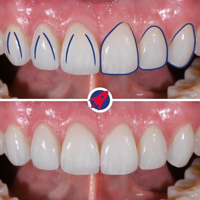 Detailaufnahme der Zahnform mit Lineangles bei Dr. Horvath: Einblick in die feine Kunst der Zahnästhetik, die für die individuelle Schönheit eines jeden Lächelns sorgt.