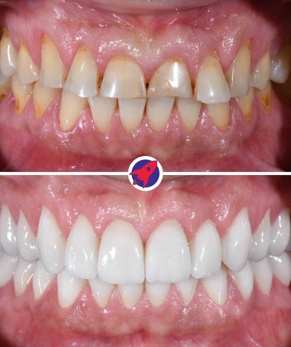 <p class="p1">Invisalign and crowns for function and aesthetics</p>