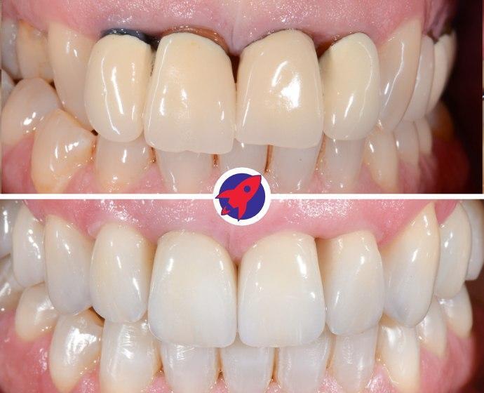 <p class="p1">Clear braces and new crowns for improved aesthetics</p>