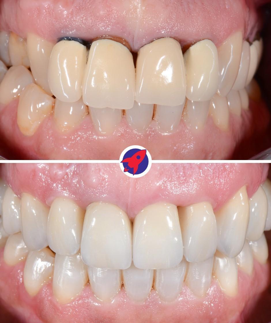 <p class="p1">Clear braces and new crowns for improved aesthetics</p>
