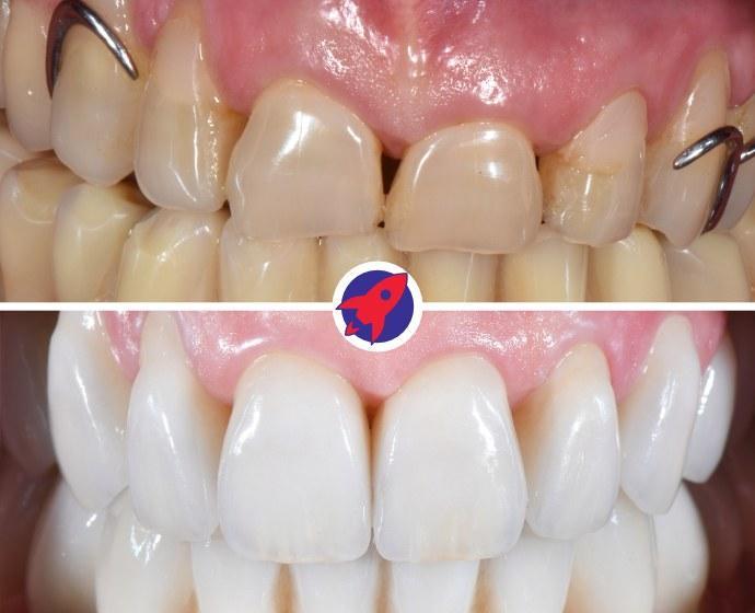 <p class="p1">Implants and crowns for improved quality of life</p>