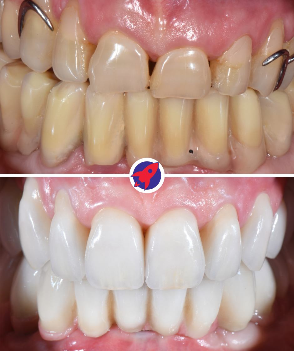 <p class="p1">Implants and crowns for improved quality of life</p>