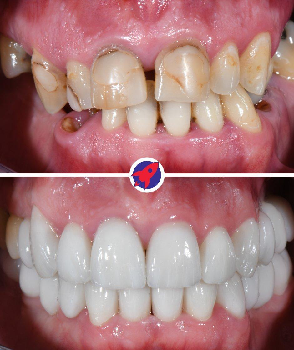 <p class="p1">Comprehensive solution for complex dental rehabilitation</p>