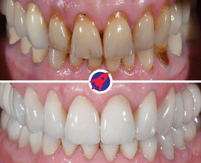<p class="p1">Implants and crowns for stability and aesthetics</p>