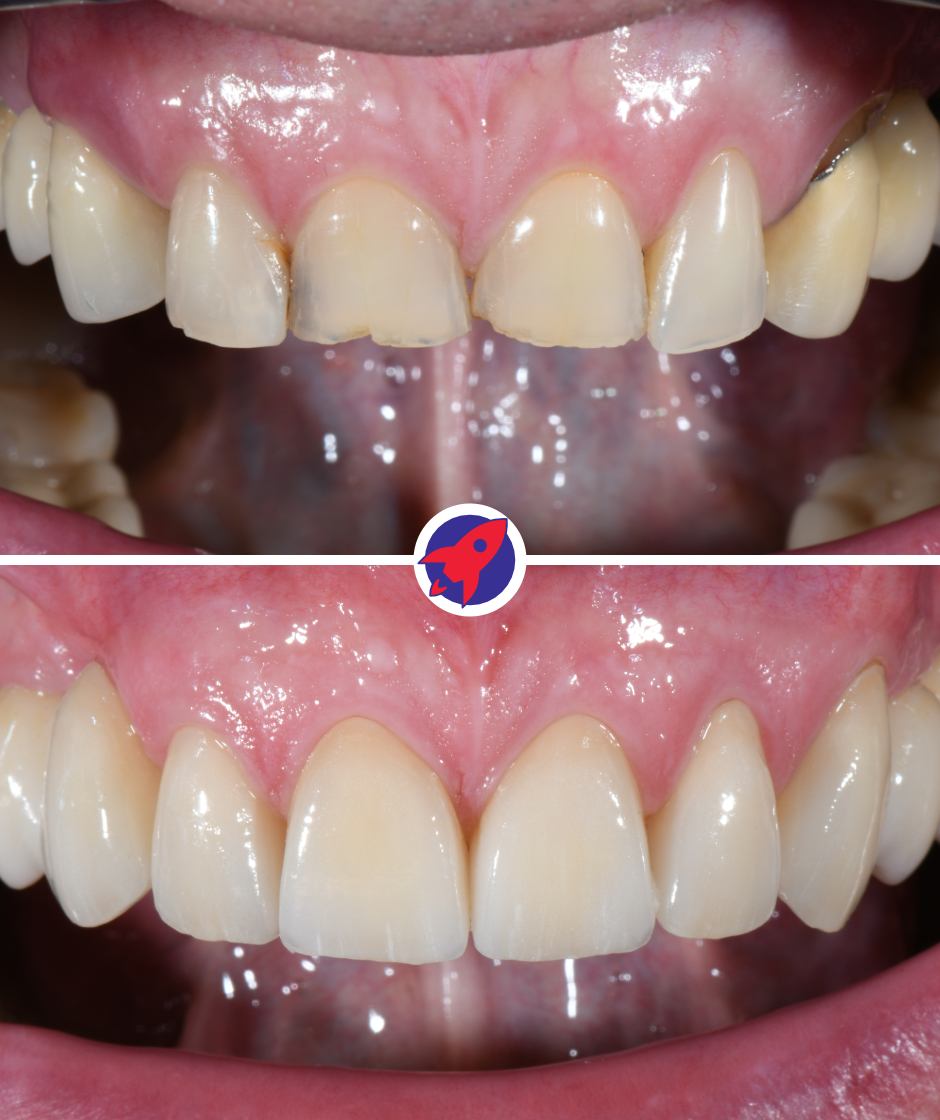 <p class="p1">Bridges and implants for a harmonious smile</p>