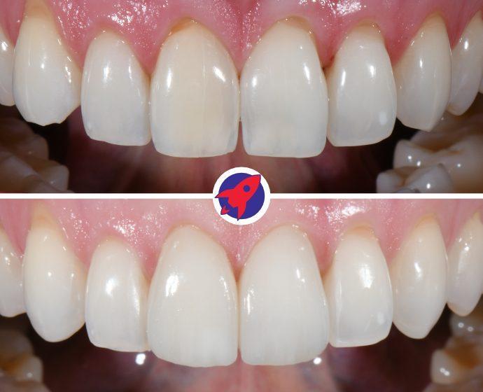 <p class="p1">Veneers limited to the central incisors</p>