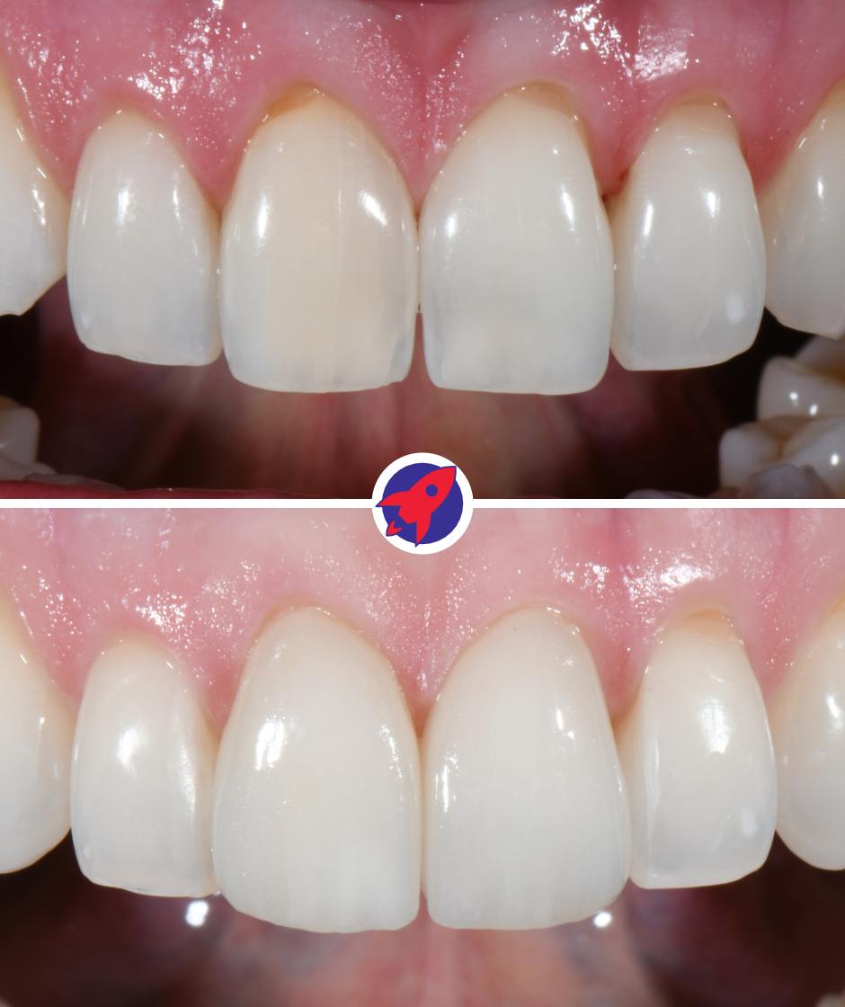 <p class="p1">Veneers limited to the central incisors</p>