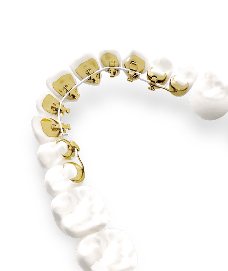 <p class="p1">Aligners, ceramic <span class="s1">or</span> lingual brackets – we choose what fits your goals <span class="s1">and</span> lifestyle.</p>